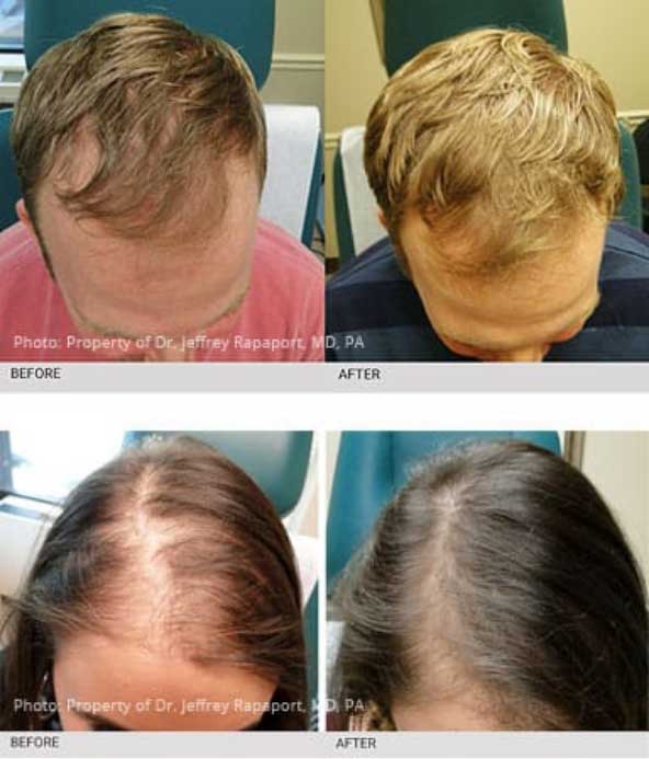 PRP Treatments for Hair Loss and Skin Rejuvenation  Dr Shapiro Aesthetic  Plastic Surgery  Skin Klinic