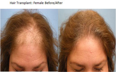 Advanced fut hair transplants dfw - Hair Restoration Institute