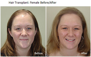Women's Advanced FUT Hair Transplantation - Hair Restoration Institute