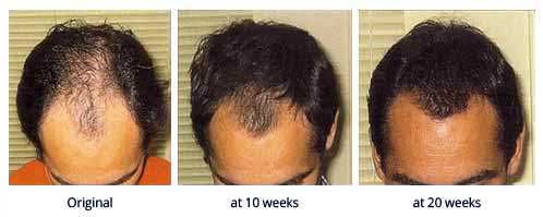 Laser Hair Growth Treatment Service