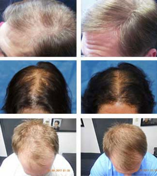 Hair loss treatment Laser therapy  benefits and side effects explained   Expresscouk