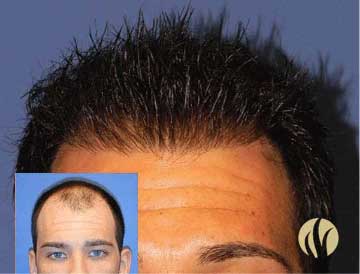 Men's Advanced FUT Hair Transplantation - Hair Restoration Institute