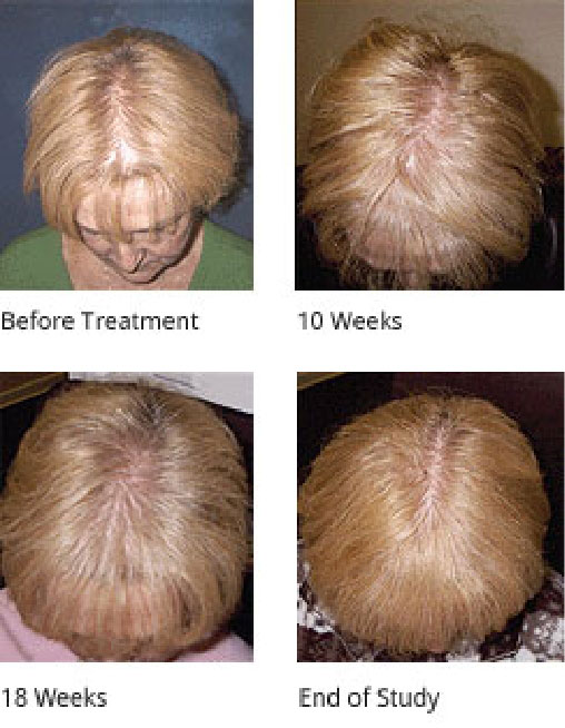 laser light therapy for hair loss