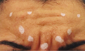 Befor Botox Treatment