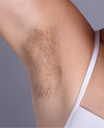 Hair Removal Service