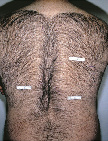 Laser Hair Removal in Peabody