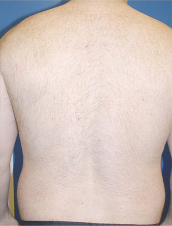 Hair Removal Service in Lexington