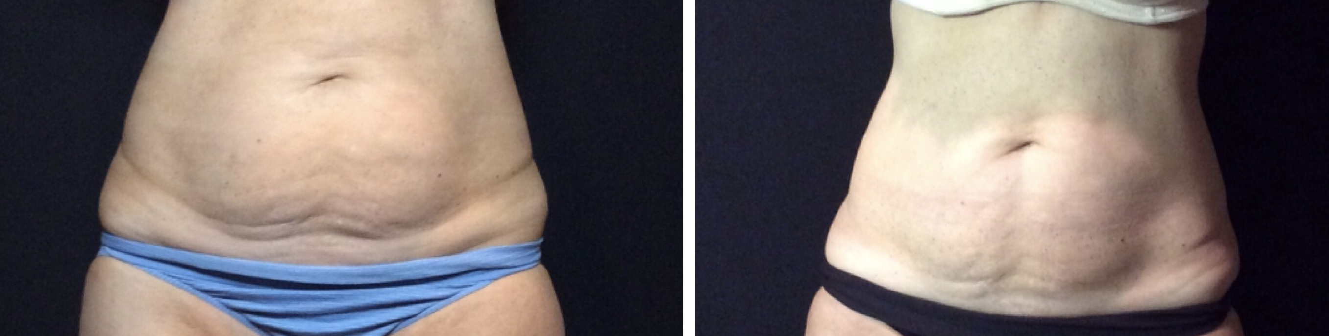 CoolSculpting or Liposuction?