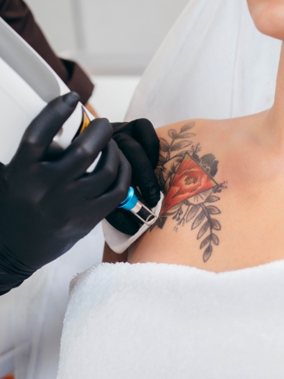 Tattoo Removal with PicoSure