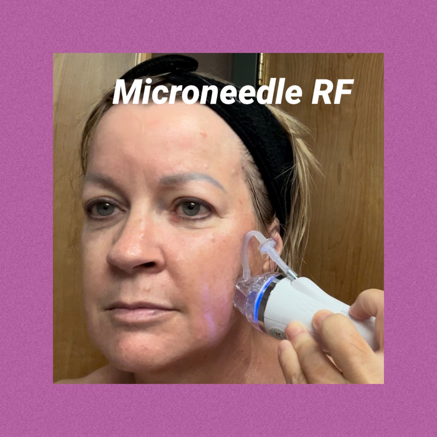 Microneedling with Radio Frequency