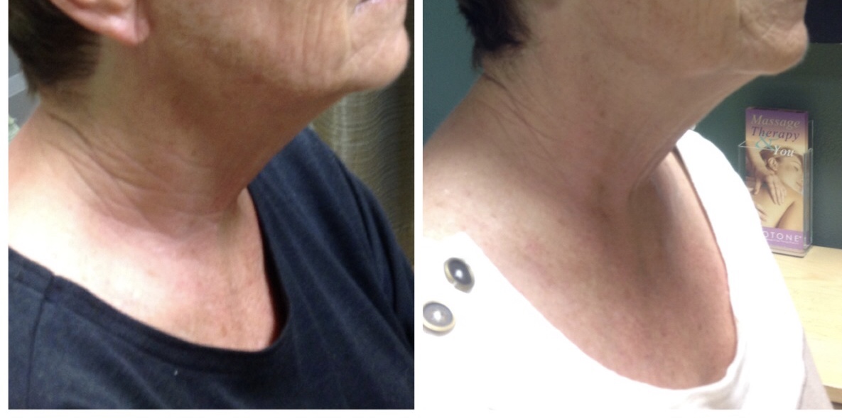 Neck Tightening ClearLift, Kybella Treatment in Honolulu